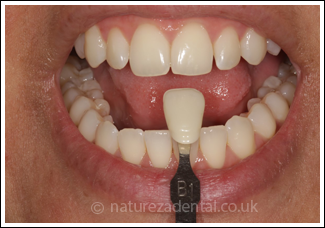 teeth-whitening1-after