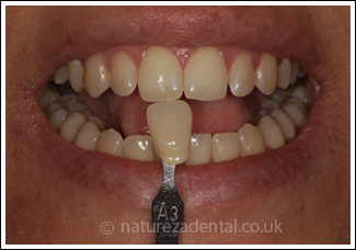 before-teeth-whitening (1)