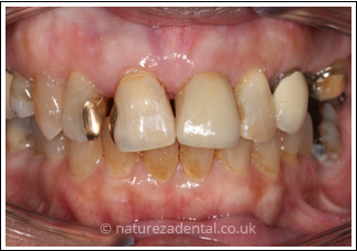 implant-1-after