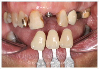 implant-1-before