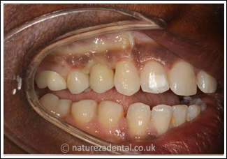implant-10-after