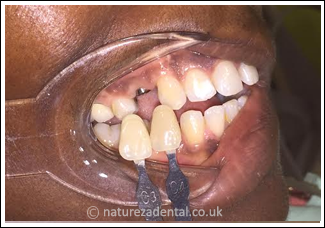 implant-10-before