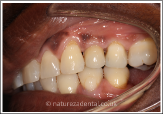 implant-2-after