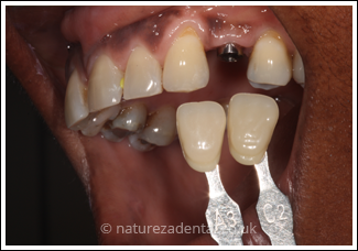 implant-2-before