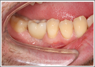 implant-3-after