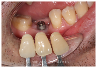 implant-3-before