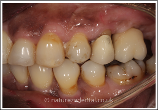 implant-4-after