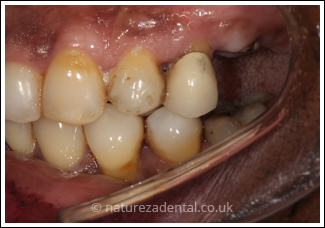 implant-4-before