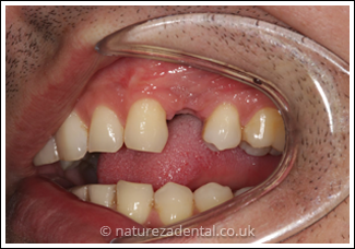 implant-5-before