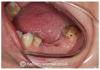 implant-6-before