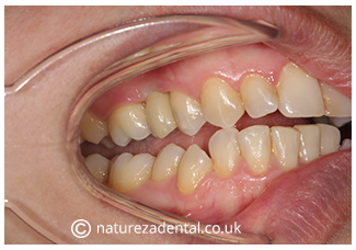 implant-7-after