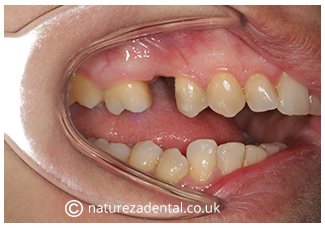 implant-7-before