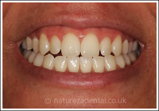 teeth-whitening2-after