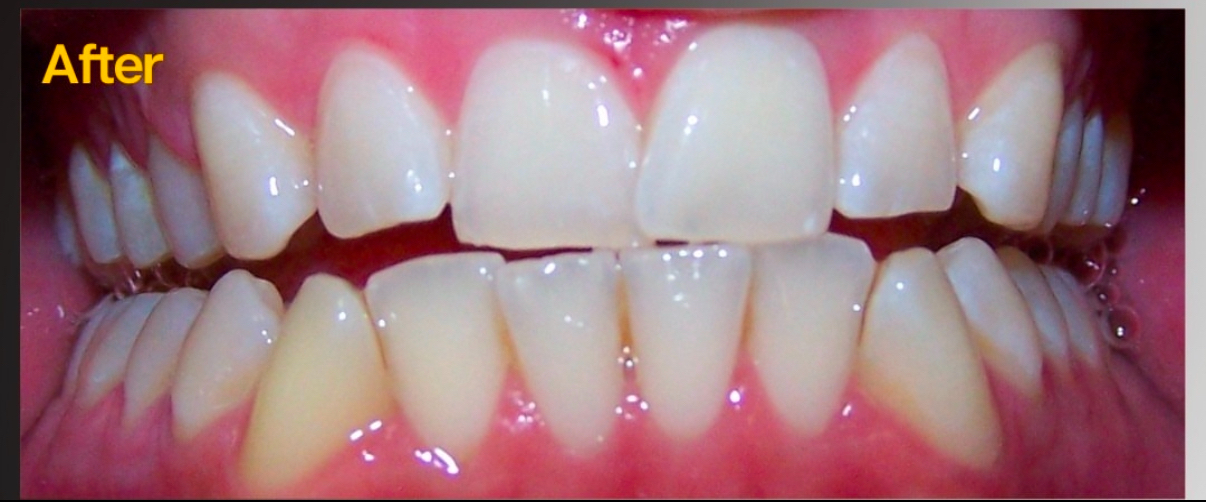 After Whitening